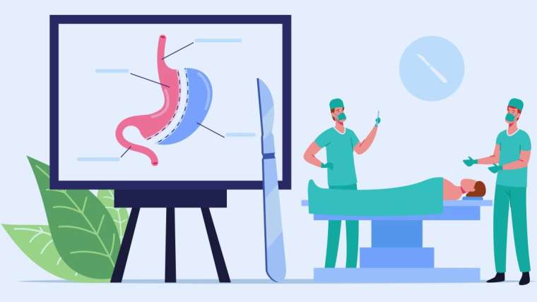 Understanding Gastric Sleeve Surgery