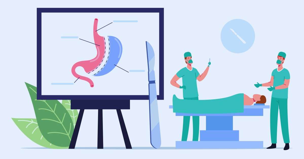 Understanding Gastric Sleeve Surgery