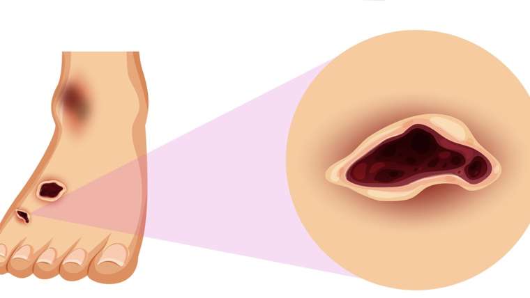What to Expect During Diabetic Foot Ulcer Treatment