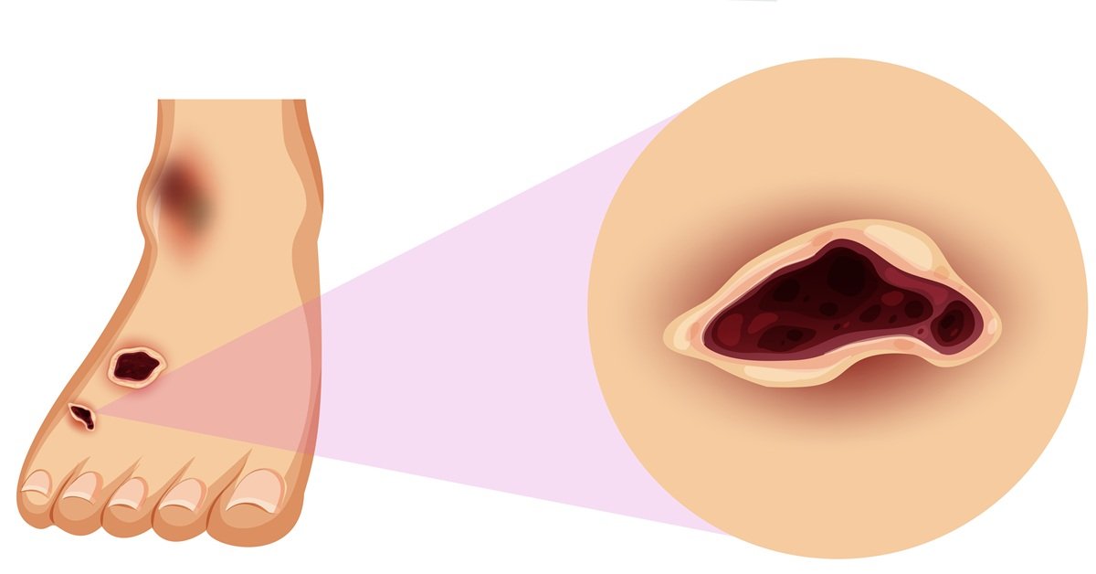 What to Expect During Diabetic Foot Ulcer Treatment